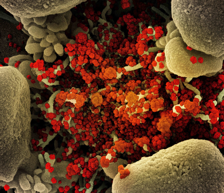This colorized scanning electron micrograph of a cell heavily infected with SARS-CoV-2 virus particles (orange/red) was captured at the NIAID Integrated Research Facility (IRF) in 2020. (NIAID via ZUMA Wire/TNS)